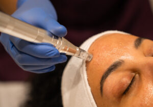 Collagen Induction Therapy & Facial Needling